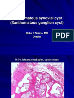 Xanthomatous Synovial Cyst (Xanthomatous Ganglion Cyst), M 74, Left Palm