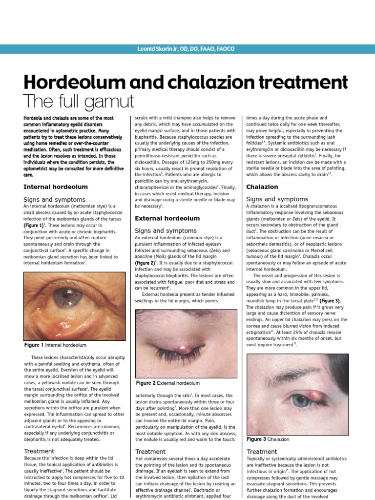 Hordeolum and Chalazion Treatment PDF Health Sciences Diseases