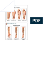 Clasificación y tipos de fracturas