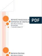 Artritis Por Depositos de Cristales