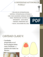 Preparacion Cavitaria Clase V