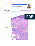 Ectopic Meningioma