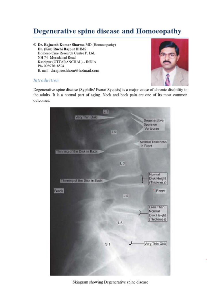 DEGENERATIVE SPINE DISEASE and Homeopathy PDF Vertebral Column Spinal Cord