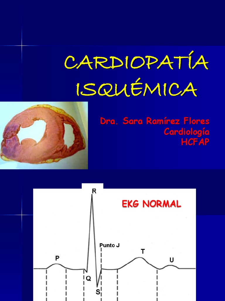 EKG en SICA e IMA | PDF | Infarto de miocardio | Electrocardiografia
