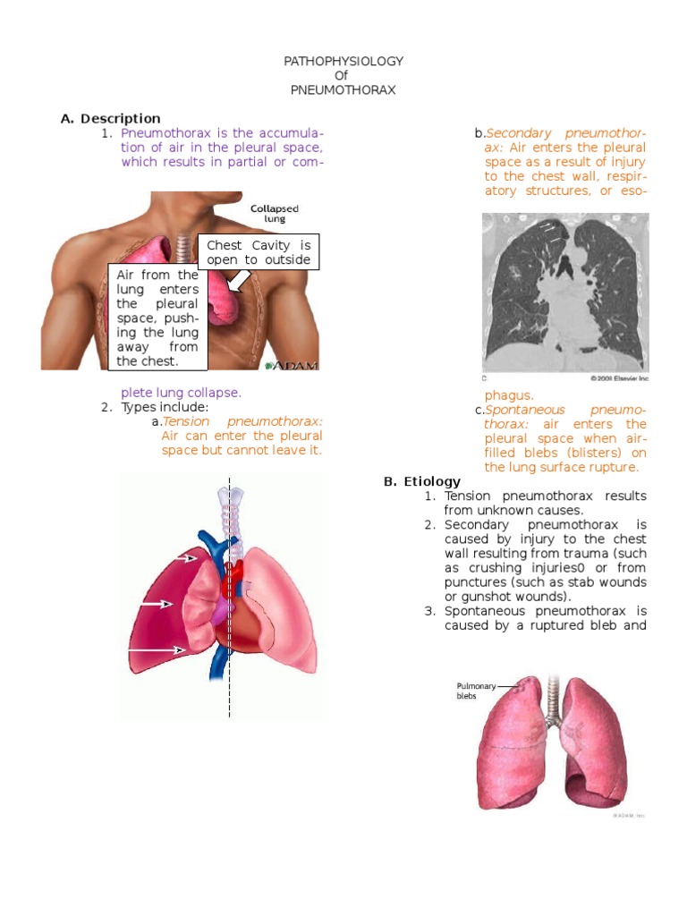 Pathophysiology of Pneumothorax PDF Thorax Pulmonology