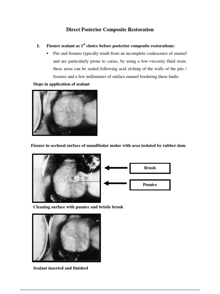 Direct Posterior Composite 1 | PDF | Dental Composite | Tooth Enamel