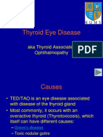 Thyroid Eye Disease: Aka Thyroid Associated Ophthalmopathy