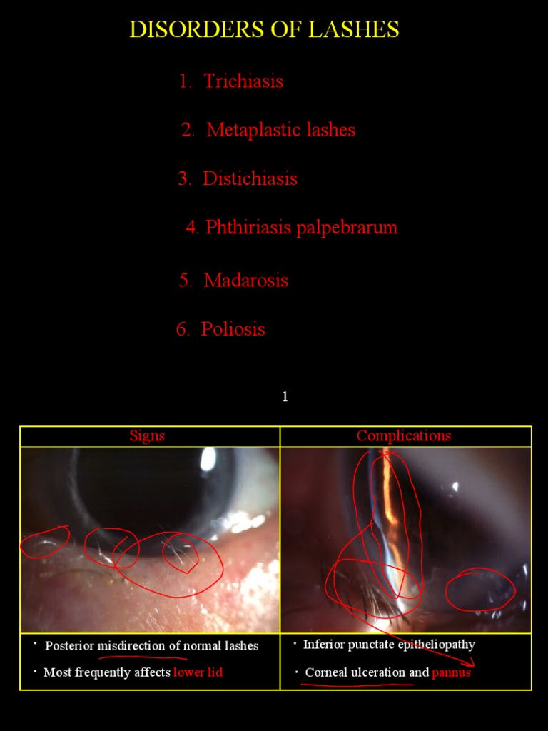 Eyelash Disorders: Types and Treatments | PDF | Science & Mathematics