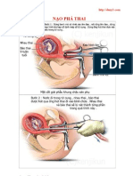 Nạo phá thai