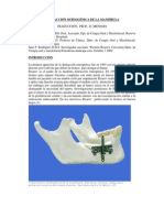 Distracción osteogénica mandibular