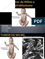 Células tumorales estrelladas de un nefroblastoma