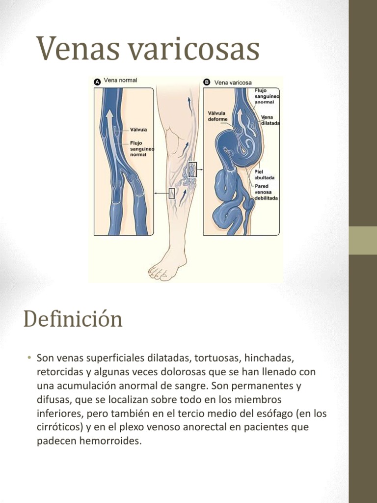 Venas varicosas Venas varicosas Pie