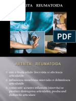 Artrita Reumatoida