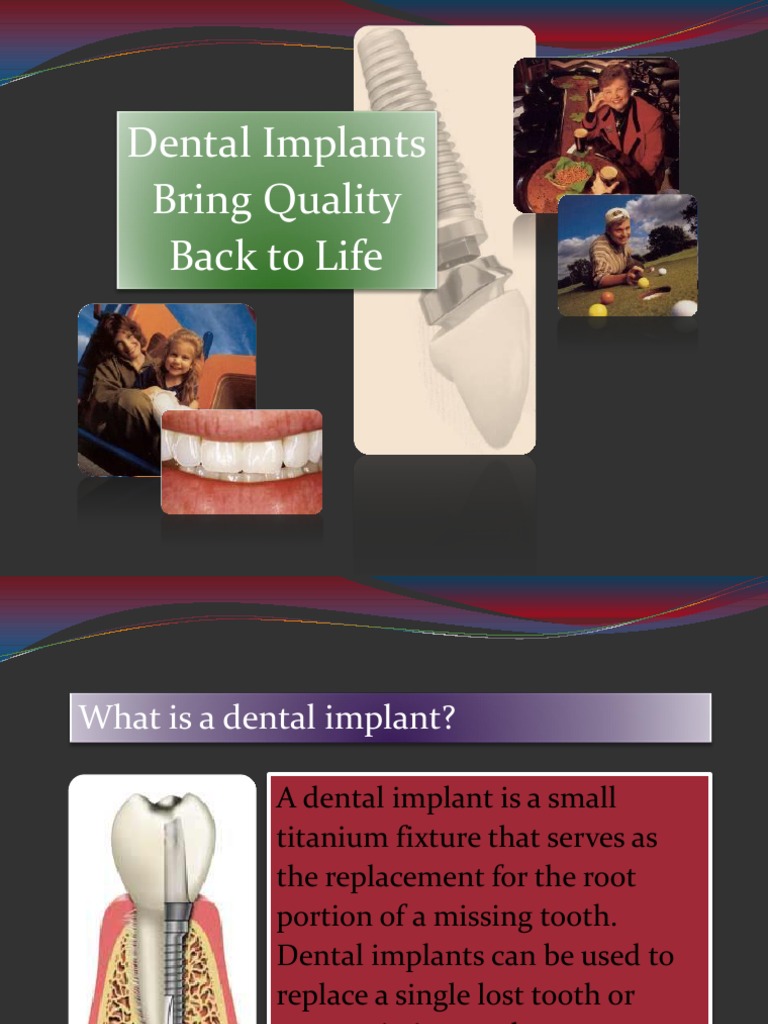 Understanding Dental Implants | PDF | Dental Implant | Human Tooth