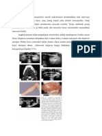 Osteomyelitis