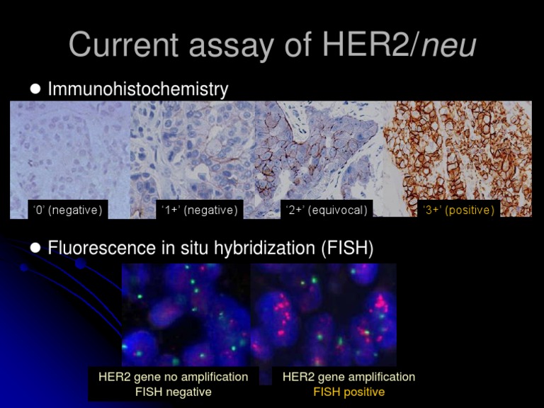 Current Assay of HER2/neu: Immunohistochemistry | PDF