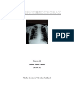 Hid Ro Pneumothorax