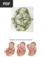 Download Breech Presentation  by lieynna4996 SN136642568 doc pdf
