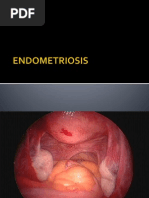 Download ENDOMETRIOSISppt by Susi Indriastuti SN136825777 doc pdf