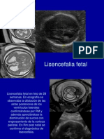 Lisencefalia Fetal