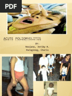 Acute Poliomyelitis: BY: Reojano, Jeriby R. Paroginog, Charis