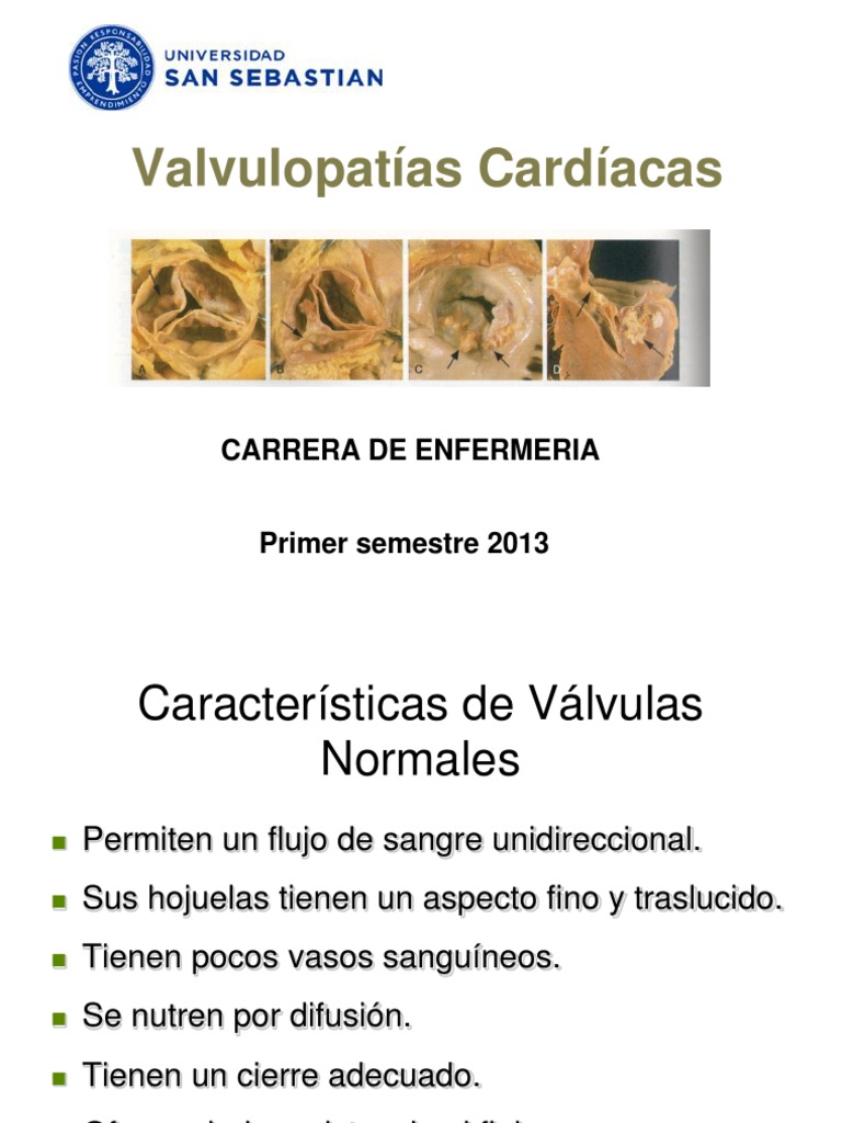 Valvulopatias Cardiacas Corazon Sistema Circulatorio
