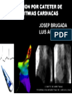 Ablacion Cateter Arritmias Cardiacas