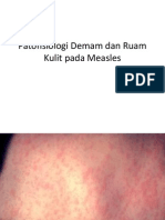 Patofisiologi Demam Dan Ruam Kulit Pada Measles