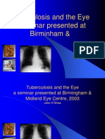 Tuberculosis and The Eye