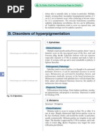 B. Disorders of Hyperpigmentation: 1. Ephelides