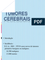 tumores-cerebrais