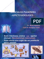 Tuberculoza Pulmonara-Aspecte Radiologice