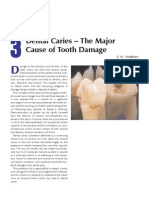 3 Dental Caries The Major Cause of Tooth Damage