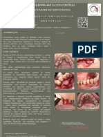 Remoção de Torus Mandibular - Relato de Caso