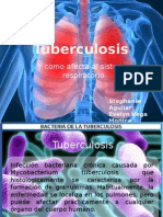 Tuberculosis