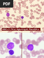 AcuteLymphoblasticLeukemia.pdf