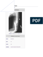 Fractura Del Húmero