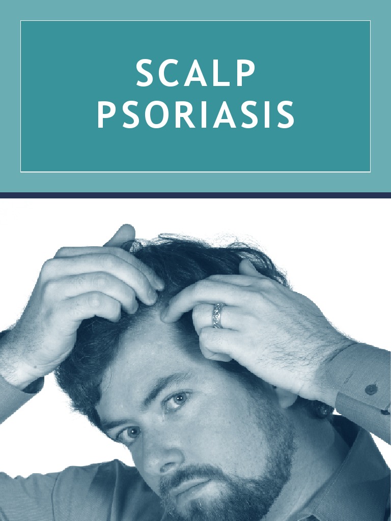 Scalp Psoriasis PDF Psoriasis Topical Medication