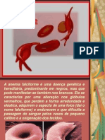 Anemia Falciforme