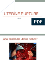 Uterine Rupture Guide: Causes, Risks, Diagnosis & Management