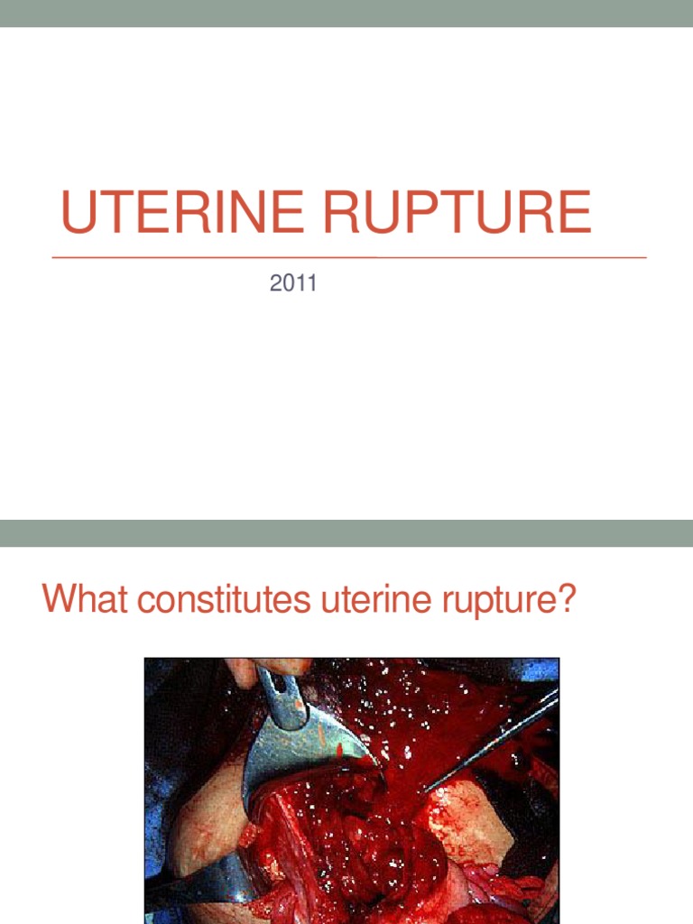 Uterine Rupture | PDF | Childbirth | Caesarean Section