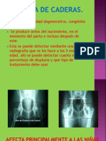 Displasia de Caderas