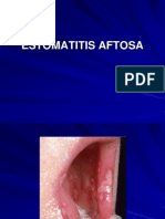 Estomatitis Aftosa Recurrente