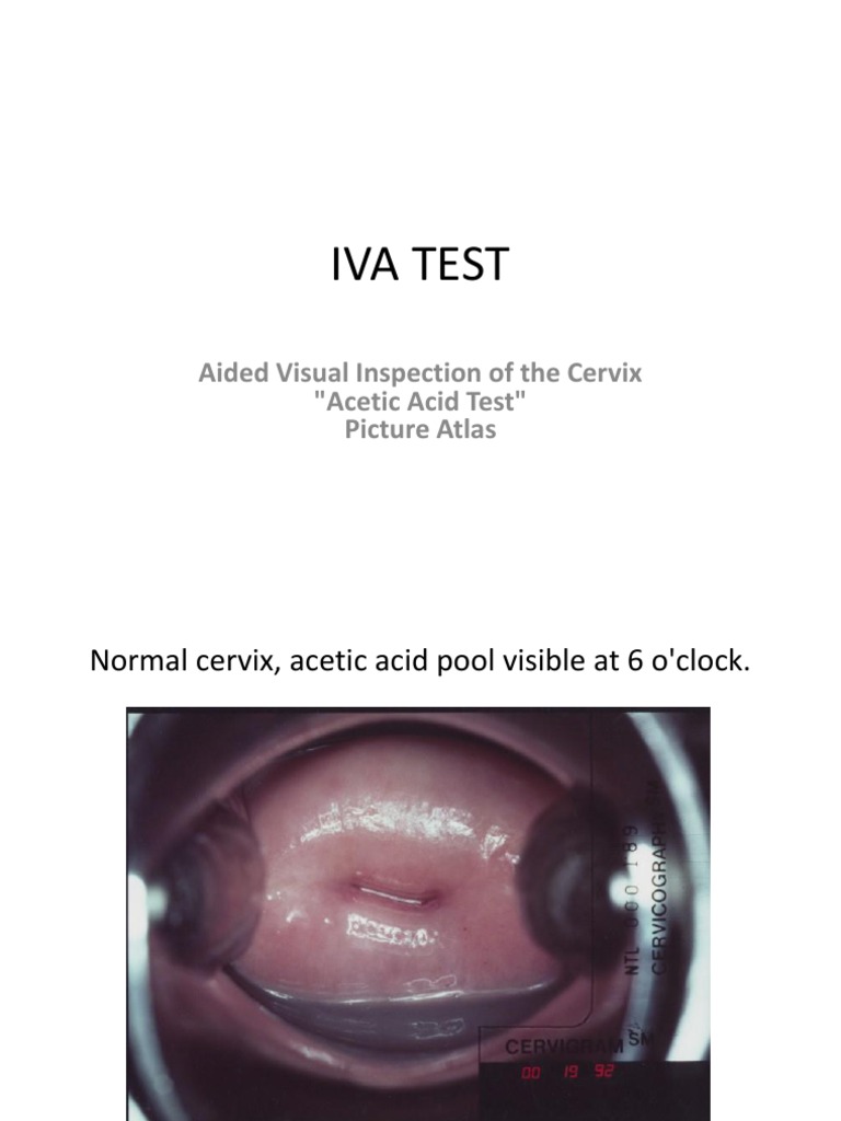 IVA Test: Cervical Inspection Guide | PDF | Science & Mathematics