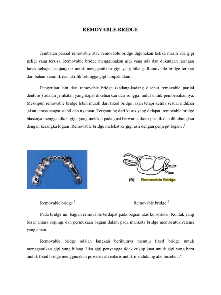 Removable Bridge | PDF