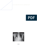 asbestosis (1)