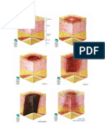 Stages of Decubitus Ulcer