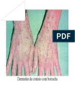 Dermatite de Contato Com Borracha