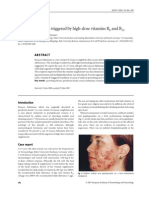 Rosacea Fulminans Triggered by High-Dose Vitamins B6 and B12