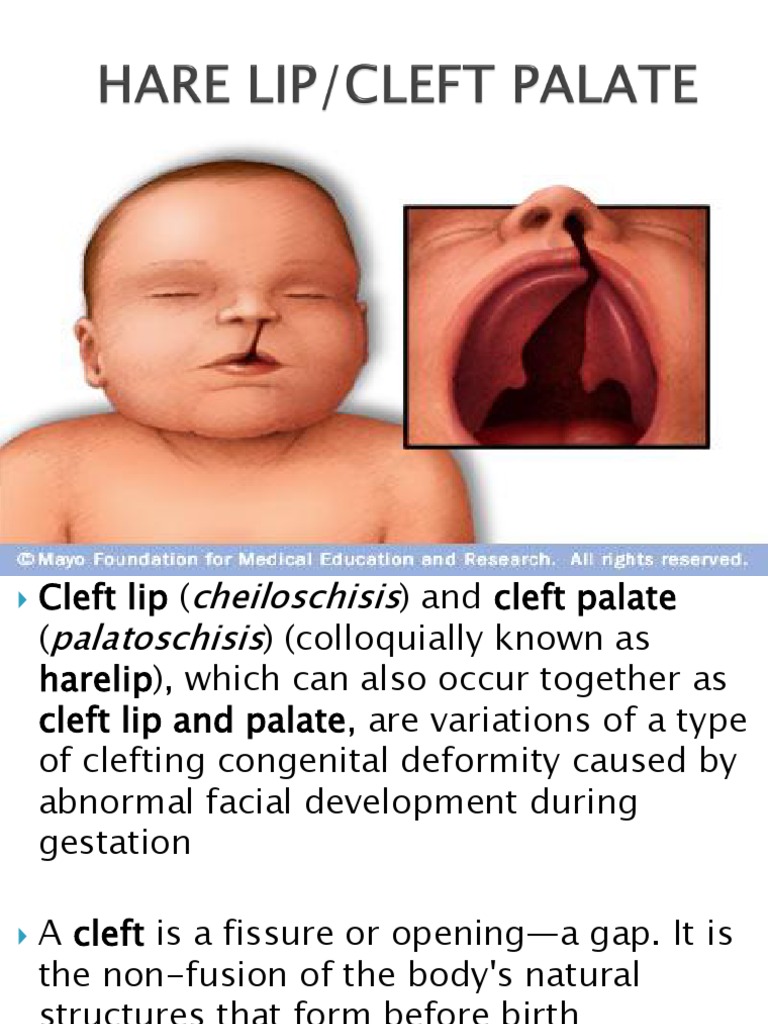 Cleft Lip Palate | PDF | Human Anatomy | Medical Specialties